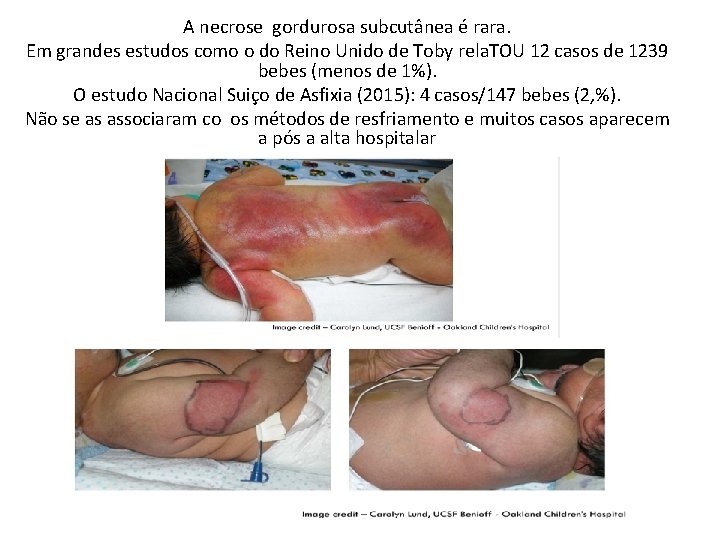 A necrose gordurosa subcutânea é rara. Em grandes estudos como o do Reino Unido