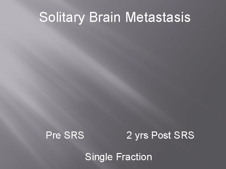 Solitary Brain Metastasis Pre SRS 2 yrs Post SRS Single Fraction 