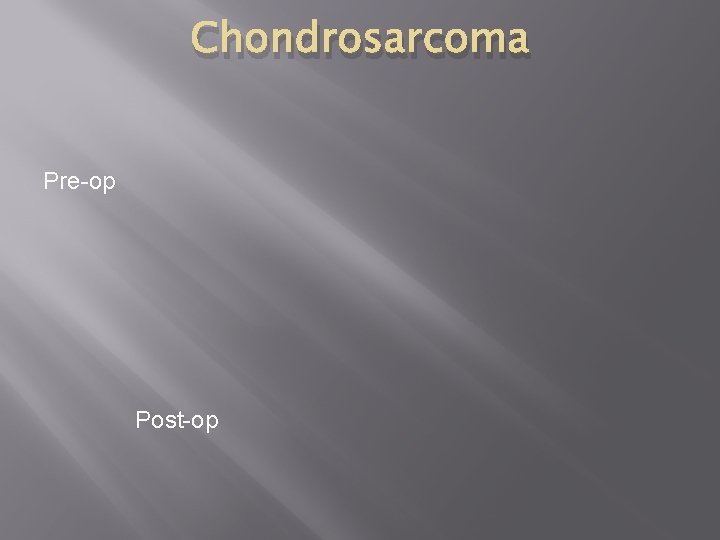 Chondrosarcoma Pre-op Post-op 