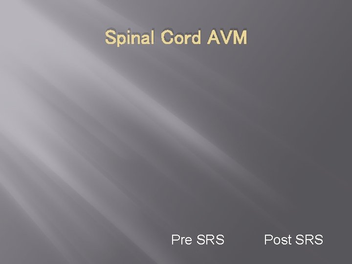 Spinal Cord AVM Pre SRS Post SRS 