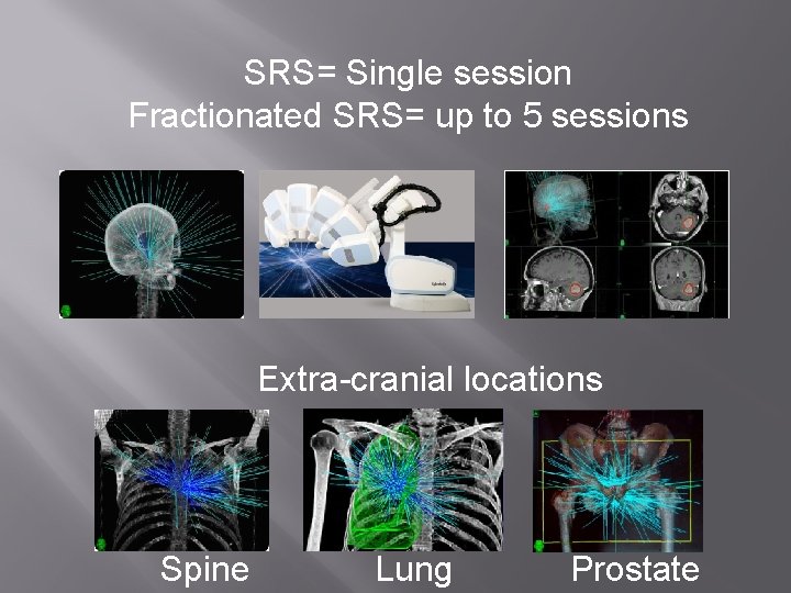 SRS= Single session Fractionated SRS= up to 5 sessions Extra-cranial locations Spine Lung Prostate SRS= Single session Fractionated SRS= up to 5 sessions Extra-cranial locations Spine Lung Prostate
