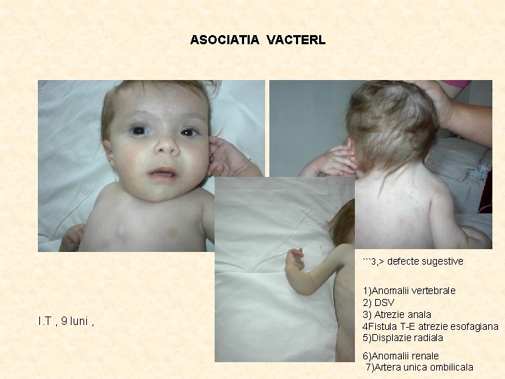 ASOCIATIA VACTERL ```3, > defecte sugestive I. T , 9 luni , 1)Anomalii vertebrale