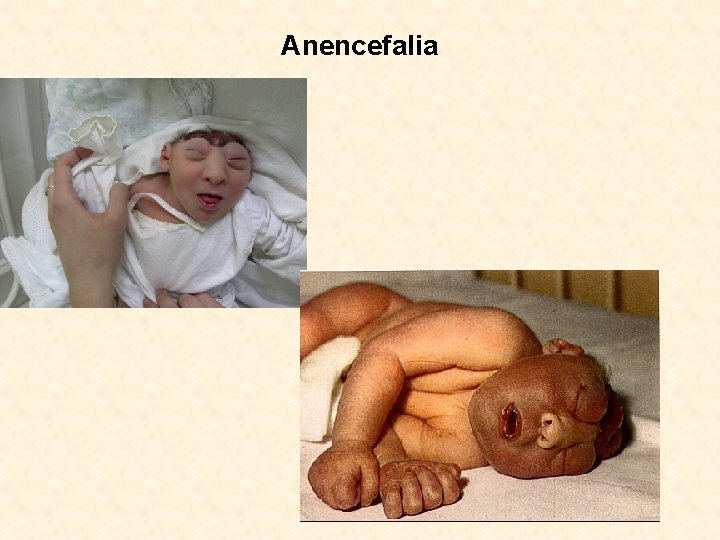 Anencefalia 