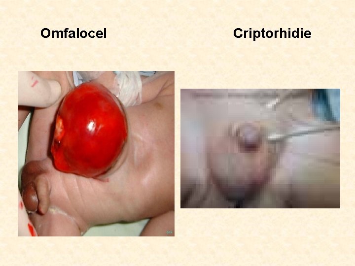 Omfalocel Criptorhidie 