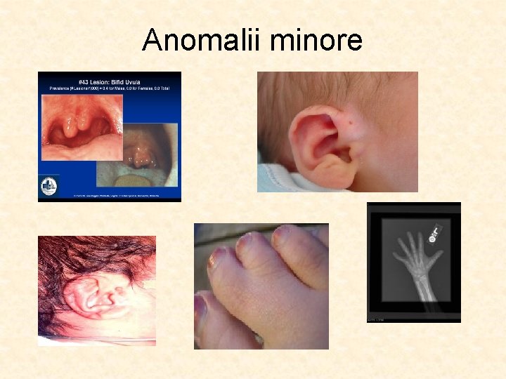 Anomalii minore 