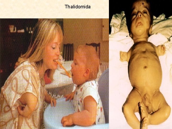 Thalidomida 