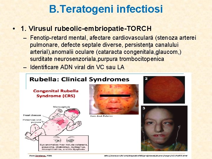 B. Teratogeni infectiosi • 1. Virusul rubeolic-embriopatie-TORCH – Fenotip-retard mental, afectare cardiovasculară (stenoza arterei