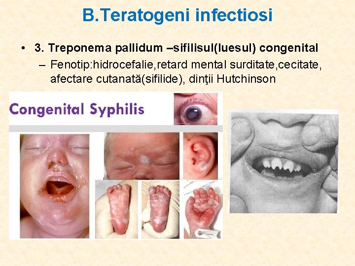B. Teratogeni infectiosi • 3. Treponema pallidum –sifilisul(luesul) congenital – Fenotip: hidrocefalie, retard mental