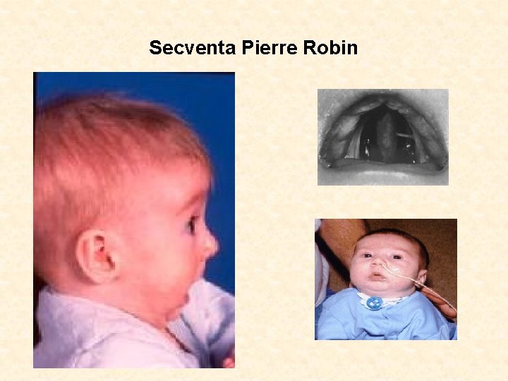 Secventa Pierre Robin 