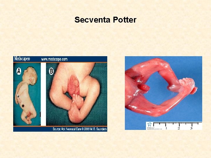 Secventa Potter 