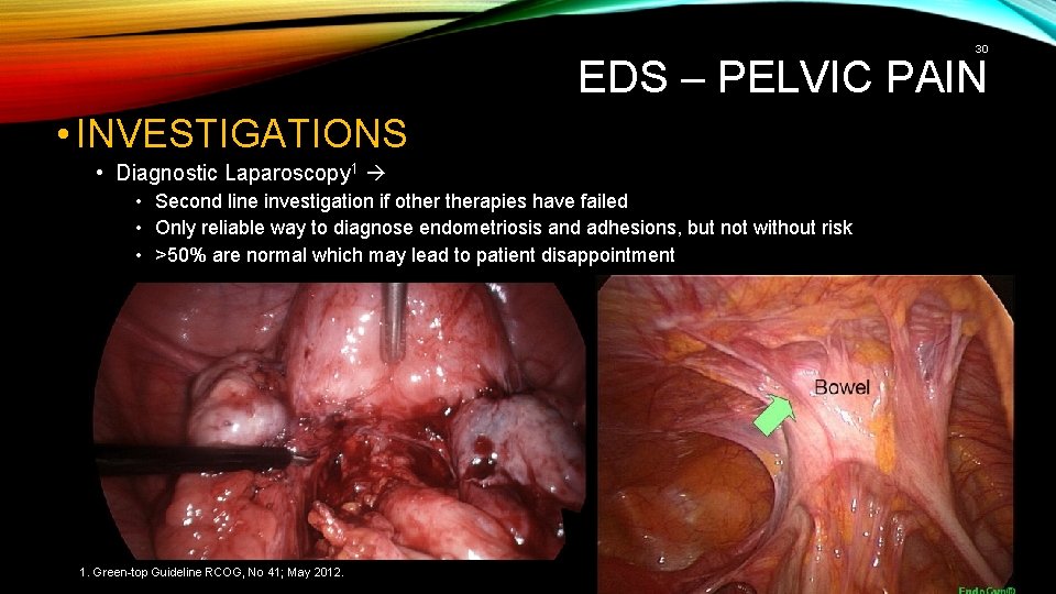 30 EDS – PELVIC PAIN • INVESTIGATIONS • Diagnostic Laparoscopy 1 • Second line 30 EDS – PELVIC PAIN • INVESTIGATIONS • Diagnostic Laparoscopy 1 • Second line