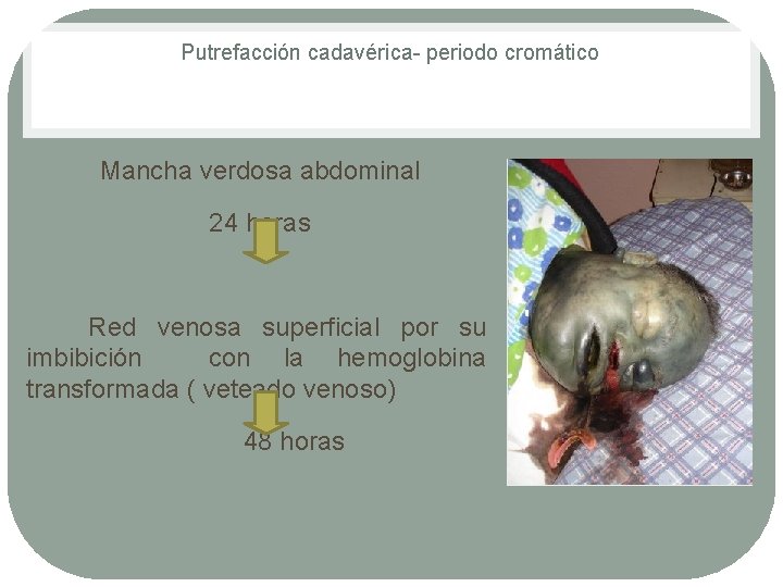 Putrefacción cadavérica periodo cromático Mancha verdosa abdominal 24 horas Red venosa superficial por su Putrefacción cadavérica periodo cromático Mancha verdosa abdominal 24 horas Red venosa superficial por su