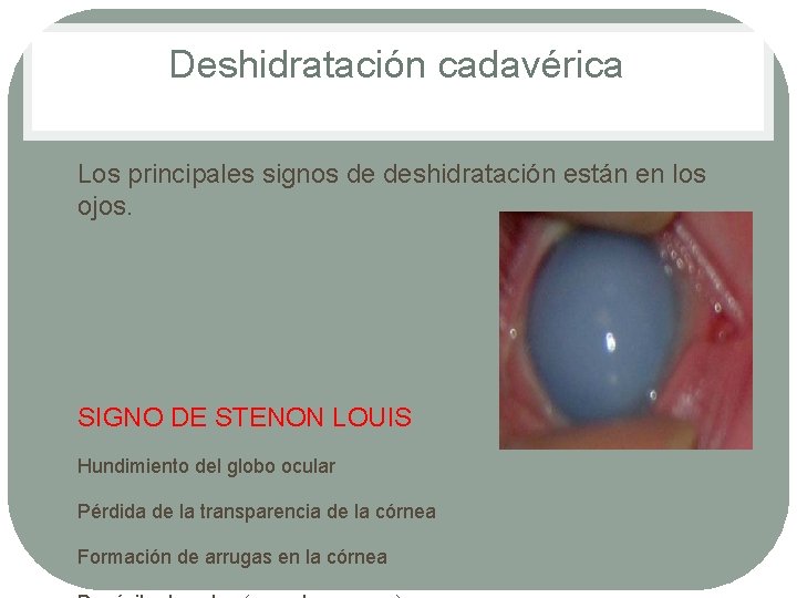 Deshidratación cadavérica • Los principales signos de deshidratación están en los ojos. • SIGNO Deshidratación cadavérica • Los principales signos de deshidratación están en los ojos. • SIGNO