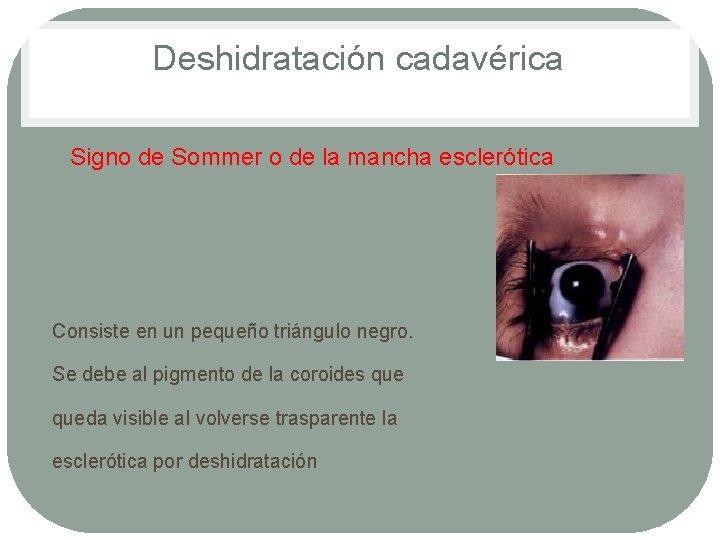 Deshidratación cadavérica • Signo de Sommer o de la mancha esclerótica Consiste en un Deshidratación cadavérica • Signo de Sommer o de la mancha esclerótica Consiste en un