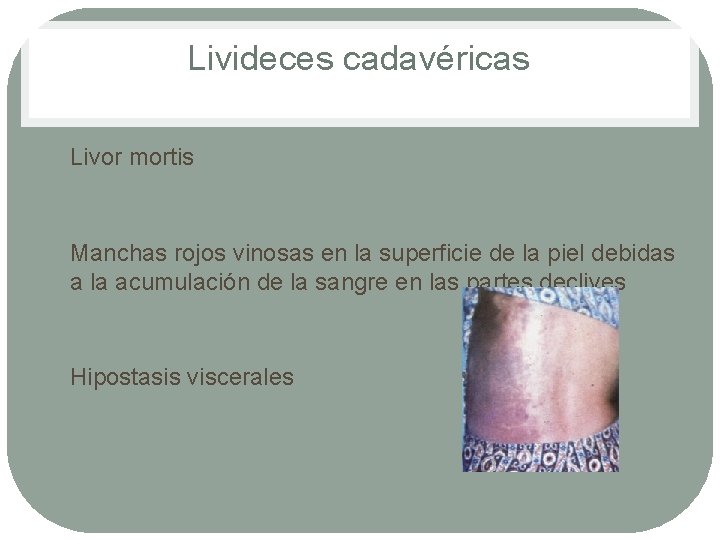 Livideces cadavéricas • • • Livor mortis Manchas rojos vinosas en la superficie de Livideces cadavéricas • • • Livor mortis Manchas rojos vinosas en la superficie de