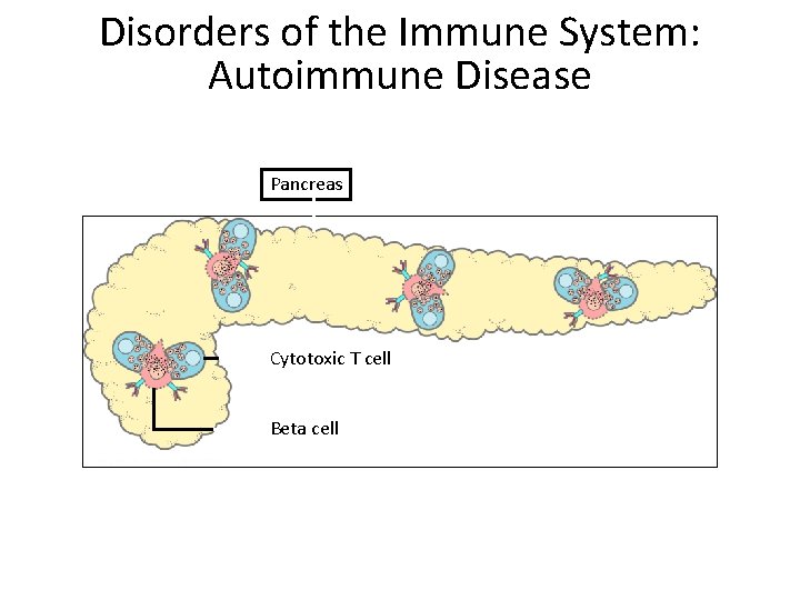 Disorders of the Immune System: Autoimmune Disease Pancreas Cytotoxic T cell Beta cell 
