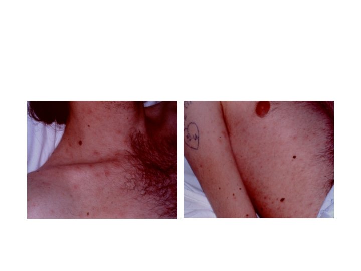 Primary HIV Syndrome - Rash 