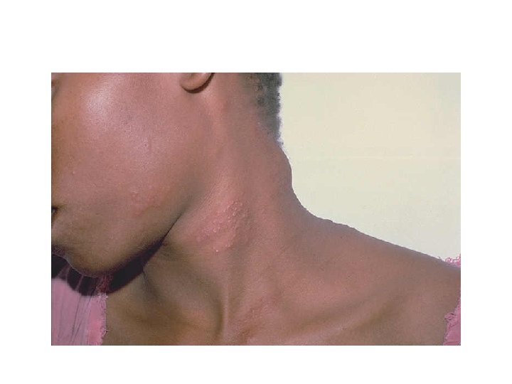 Swollen Posterior Cervical Lymph Nodes 