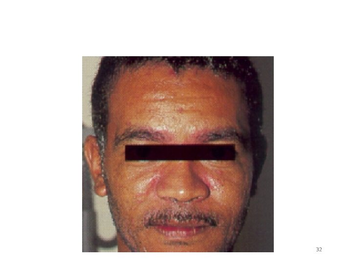 Seborrheic Dermatitis Natural History of HIV Infection 32 