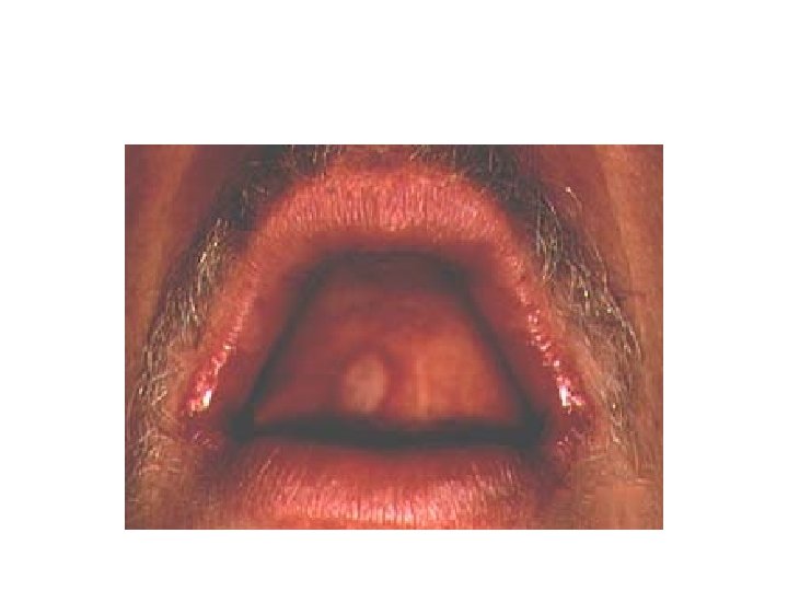 Oral HSV Ulcer and Angular Cheilitis 