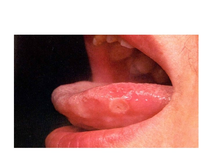 Aphthous Ulcers 