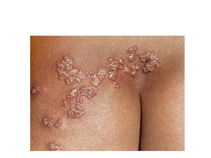 Dermatomal Herpes (Varicella) Zoster 