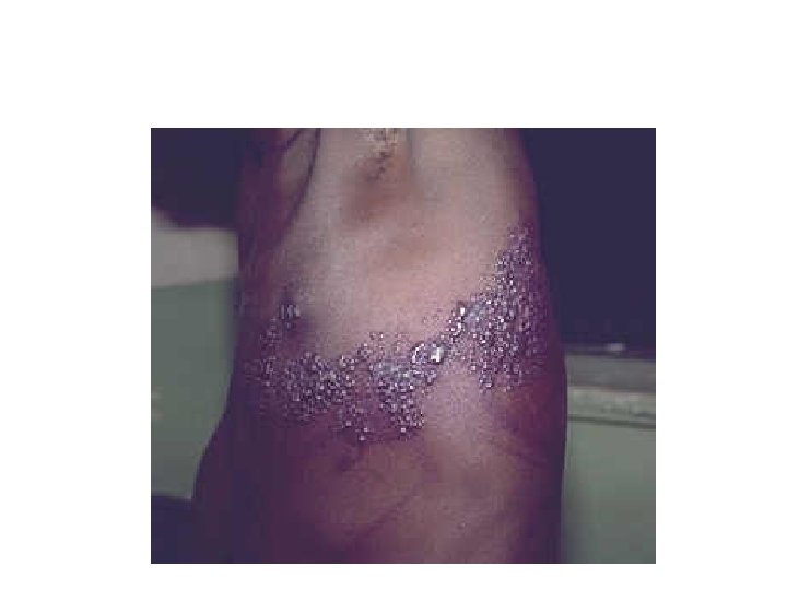 Dermatomal Herpes (Varicella) Zoster 