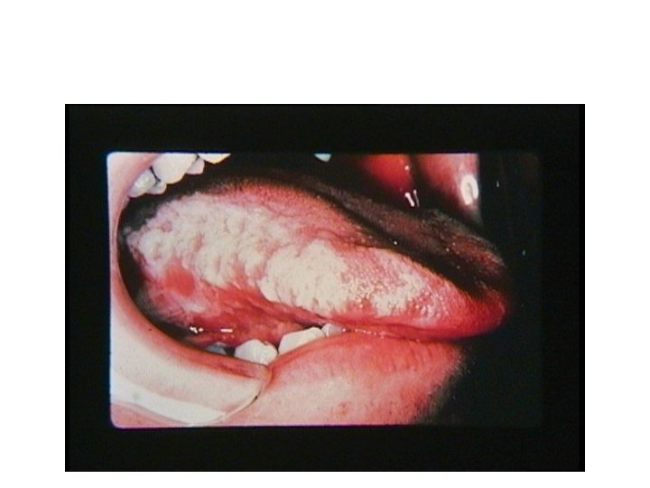 Oral Hairy Leukoplakia 