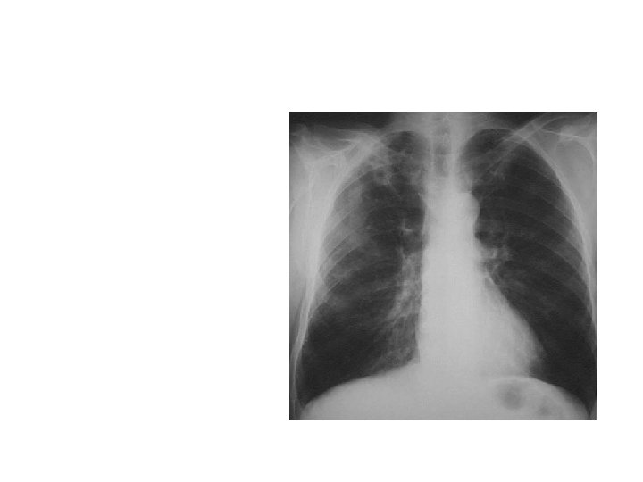 Pulmonary Tuberculosis With mild –moderate immunosuppression (CD 4 > 200) usually presents with typical