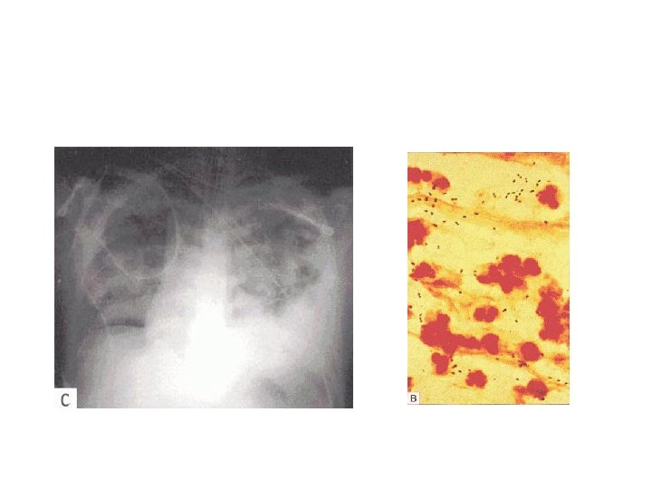 Bacterial Pneumonia Streptococcus pneumoniae 