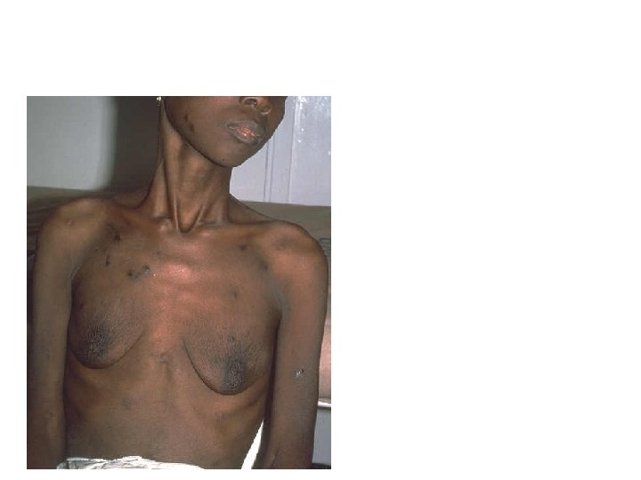 Kaposi’s Sarcoma Usually, multiple dark raised lesions. Lesions themselves are not itchy and are