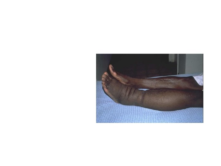Lymphedema from Kaposi’s Sarcoma Involvement of regional lymph nodes with distal edema is common.