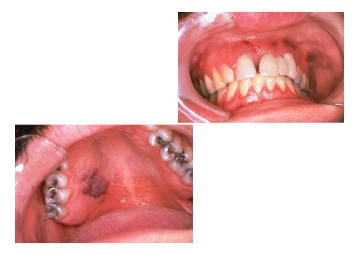 Oral Kaposi’s Sarcoma Implies involvement of internal organs such as gastrointestinal tract 