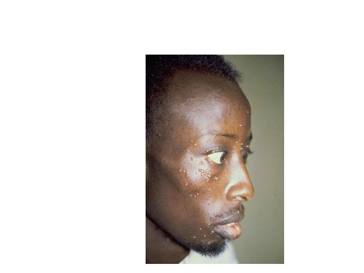 Umbilicated papules of Molluscum contagiosum and Cryptococcus have the same appearance 