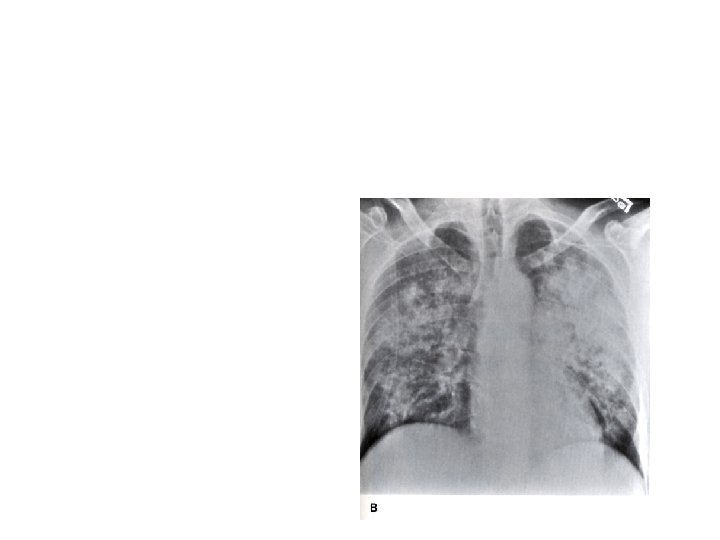 Pneumocystis carinii (jiroveci) Pneumonia or PCP Subacute or acute illness of more than one