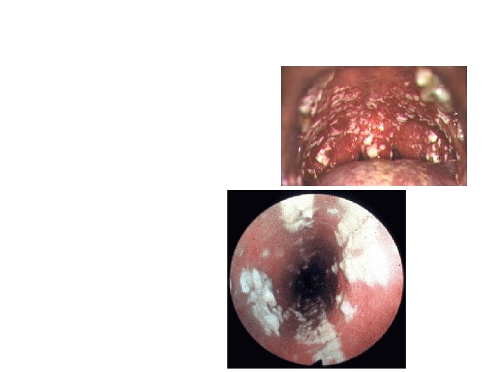 Oesophageal Candidiasis HIV infected patient with oral candidiasis and chest (sub-sternal) pain with swallowing
