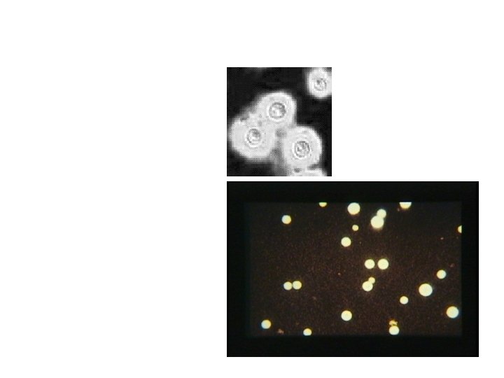 Cryptococcal Meningitis Spinal fluid: may have increased lymphocytes, may have increased protein. Budding yeast