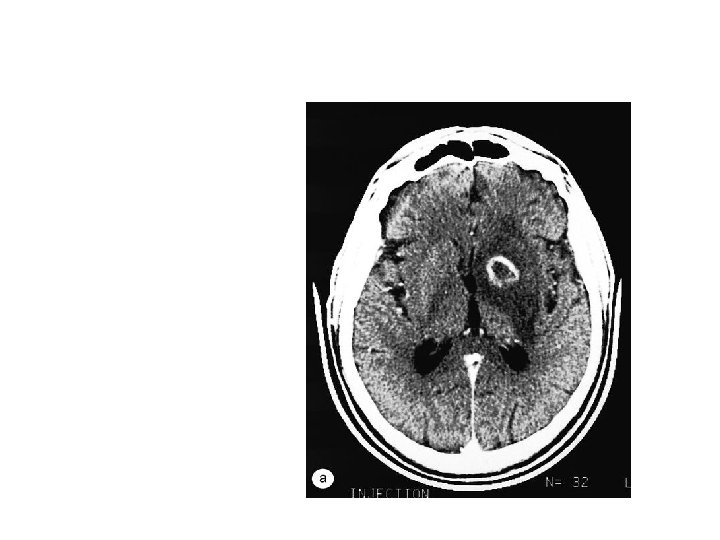 Enhancing Mass Lesion of the Brain Single ring enhancing lesion with oedema on brain