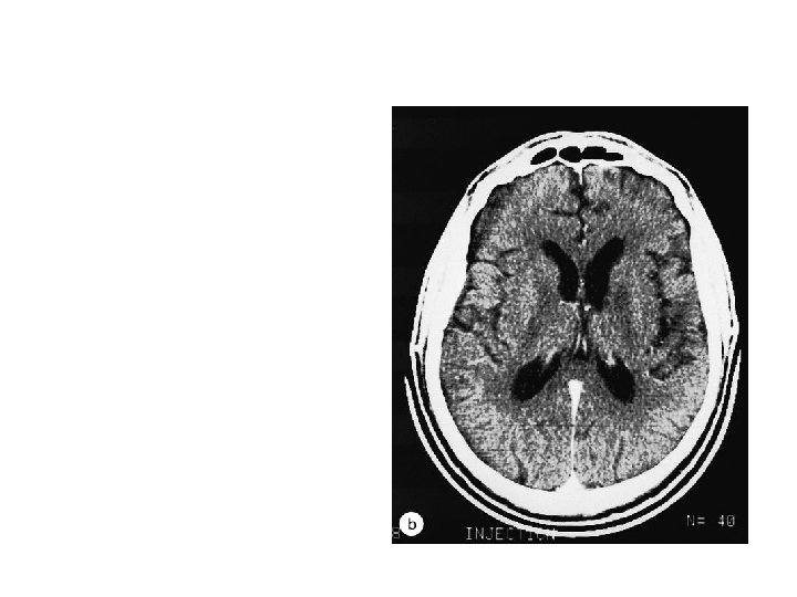 CNS Toxoplasmosis Response to empiric therapy 
