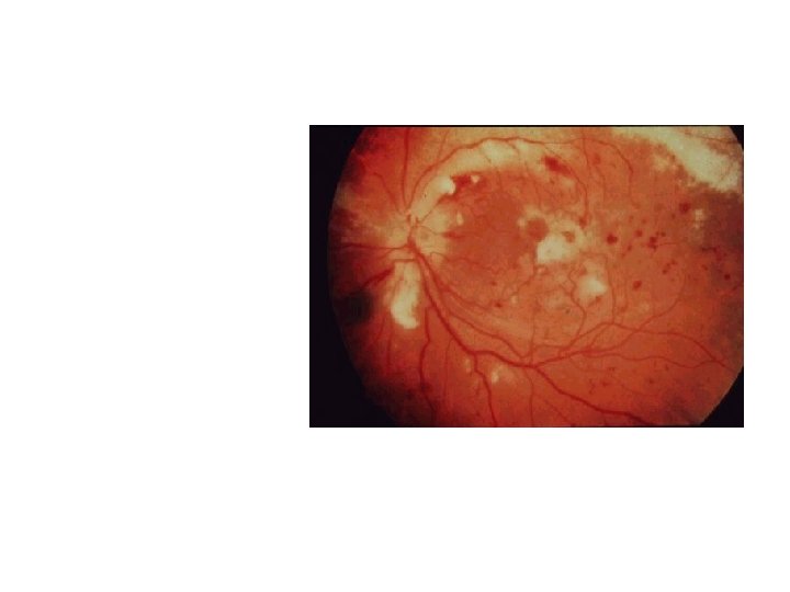 Cytomegalovirus Retinitis Afebrile patient; reduced vision in one or both eyes; painless; external eye