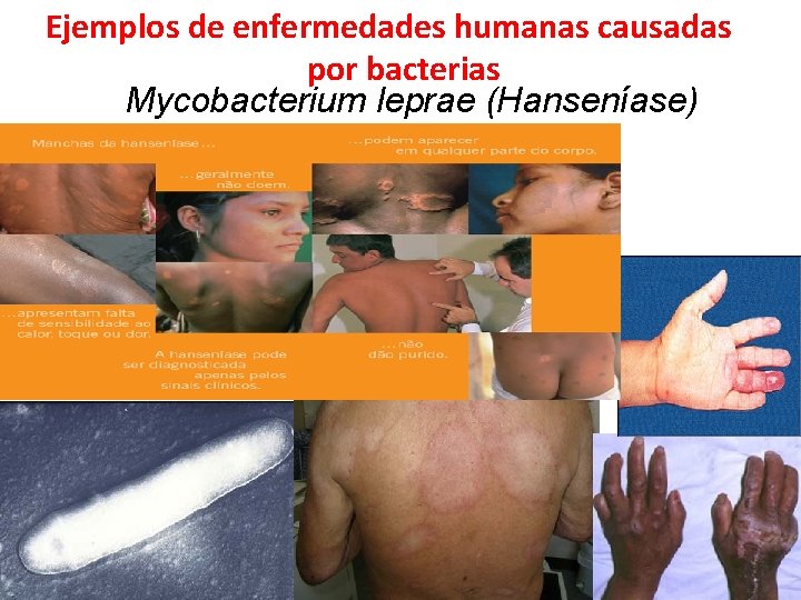 Ejemplos de enfermedades humanas causadas por bacterias Mycobacterium leprae (Hanseníase) 