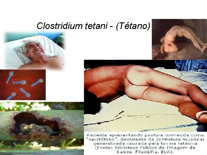 Clostridium tetani - (Tétano) 