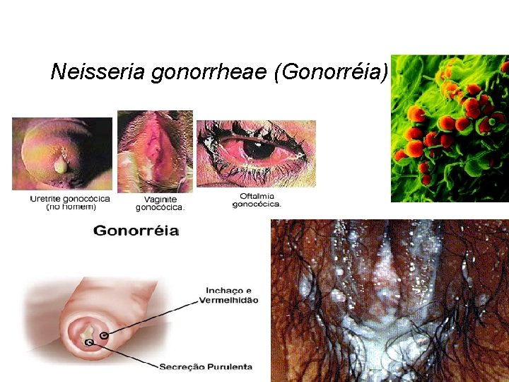 Neisseria gonorrheae (Gonorréia) 