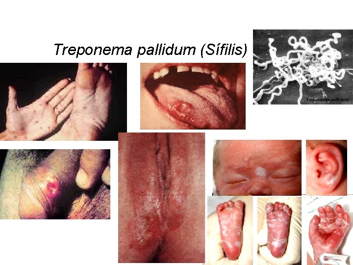 Treponema pallidum (Sífilis) 