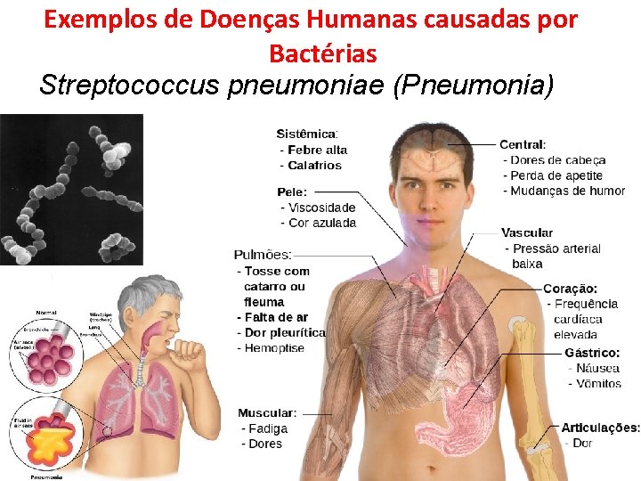 Exemplos de Doenças Humanas causadas por Bactérias Streptococcus pneumoniae (Pneumonia) 