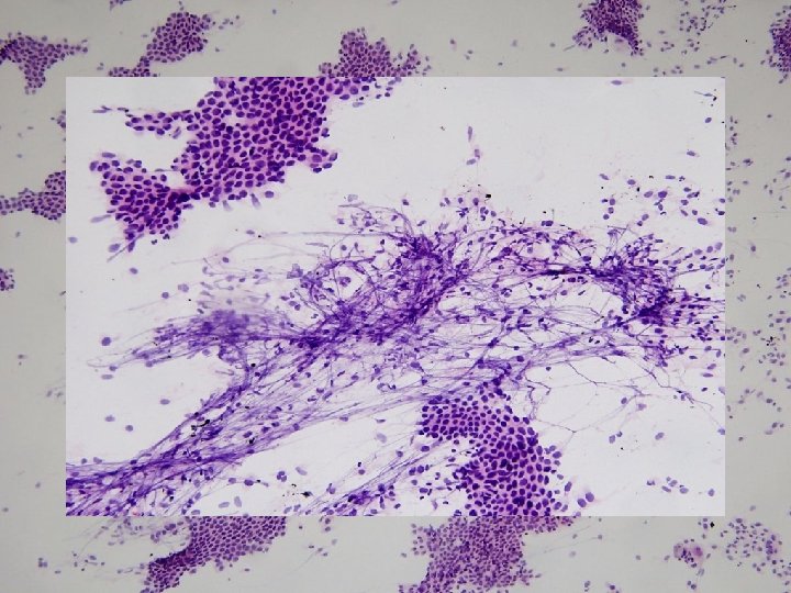 Summary of cytologic findings High cellularity Moderate to