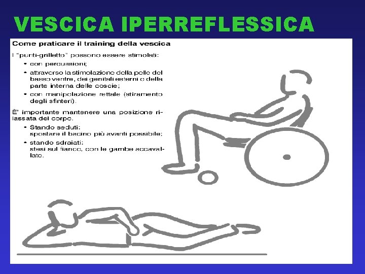 VESCICA IPERREFLESSICA 