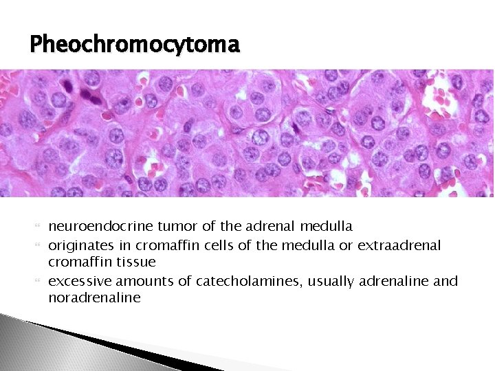Pheochromocytoma neuroendocrine tumor of the adrenal medulla originates in cromaffin cells of the medulla