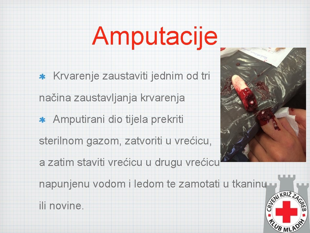 Amputacije Krvarenje zaustaviti jednim od tri načina zaustavljanja krvarenja Amputirani dio tijela prekriti sterilnom