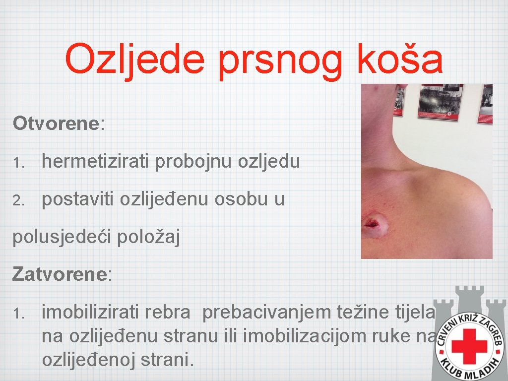 Ozljede prsnog koša Otvorene: 1. hermetizirati probojnu ozljedu 2. postaviti ozlijeđenu osobu u polusjedeći